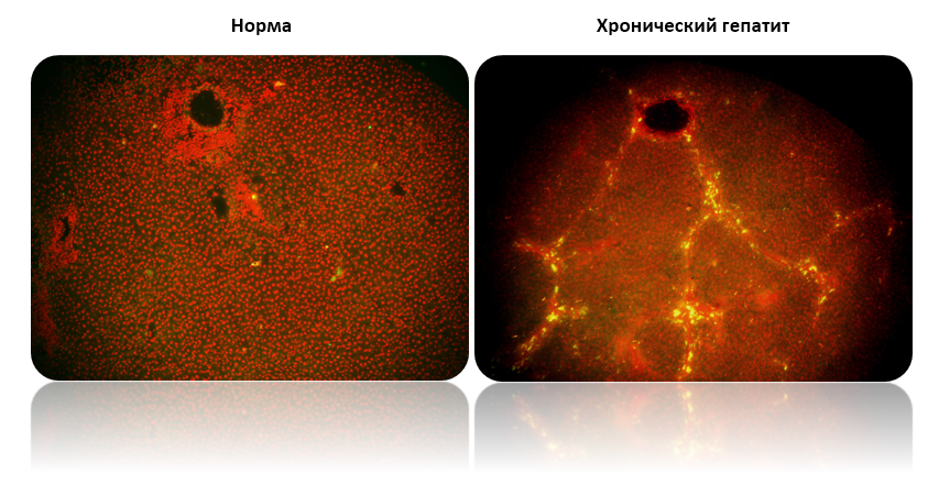 Рисунок 1 – Криосрезы ткани печени через 7 дней после трансплантации стволовых клеток меченных флуоресцентным красителем PKH 67 (зелёно-желтая флуоресценция). Ядра клеток окрашены пропидий йодидом (красное свечение).
