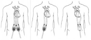 Варианты имплантации систем поддержки желудочков сердца