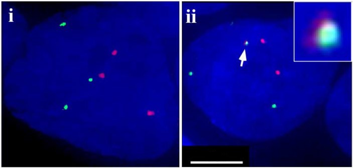 Рисунок 4 – Фотографии клеток без хромосомной перестройки (слева) и c ней, окрашенных методом FISH (зеленым и красным маркируются, соответственно, 7 и 21 хромосомы). Можно заметить, что клетки изначально имеют триплоидный набор хромосом. Перестройка была инициирована модификацией клеток минигеном антисмысловой гибридной РНК для генов TMPRSS2 и ETV1. Длина масштабного отрезка – 5 мкм.