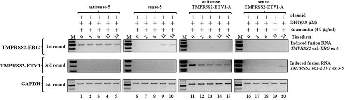 Рисунок 6 – Проверка индукции хромосомных перестроек введением минигенов смысловых или антисмысловых гибридных РНК при добавлении химического блокатора транскрипции альфа-аманитина. Ожидаемые транслокации появлялись с первого же часа при введении антисмысловых РНК, и через 12 часов (для внутрихромосомной перестройки TMPRSS2-ERG) или 24 часа (для межхромосомной перестройки TMPRSS2-ETV1) после введения смысловых гибридных РНК.