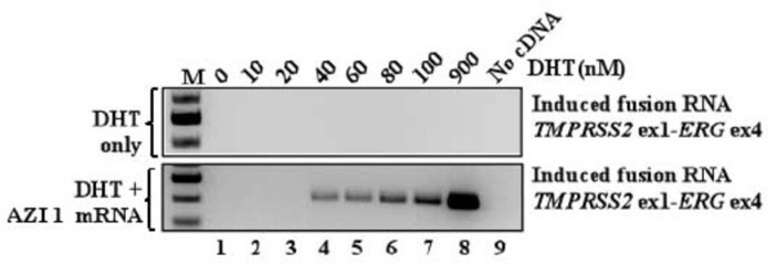 Рисунок 7 – Перестройка на хромосоме 21, приводящая к появлению гибридного гена TMPRSS2-ERG, инициируется повышенной экспрессией собственного гена некодирующей РНК AZI1.